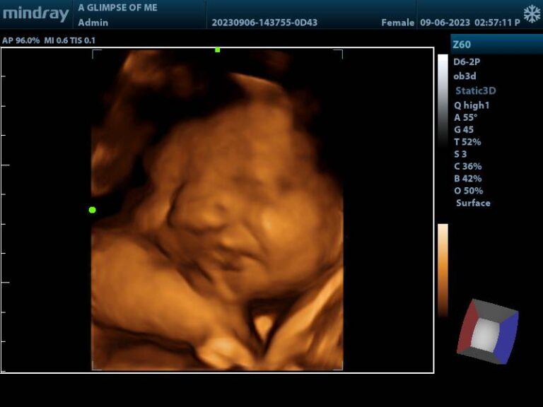 ultrasound baby image